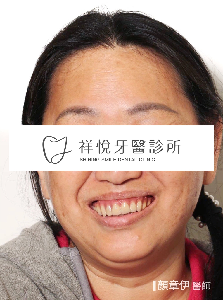 一日長城治療後