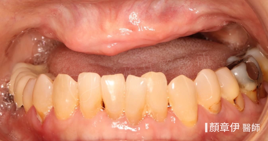 一日長城治療前