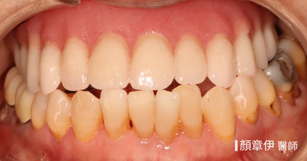 一日長城治療後