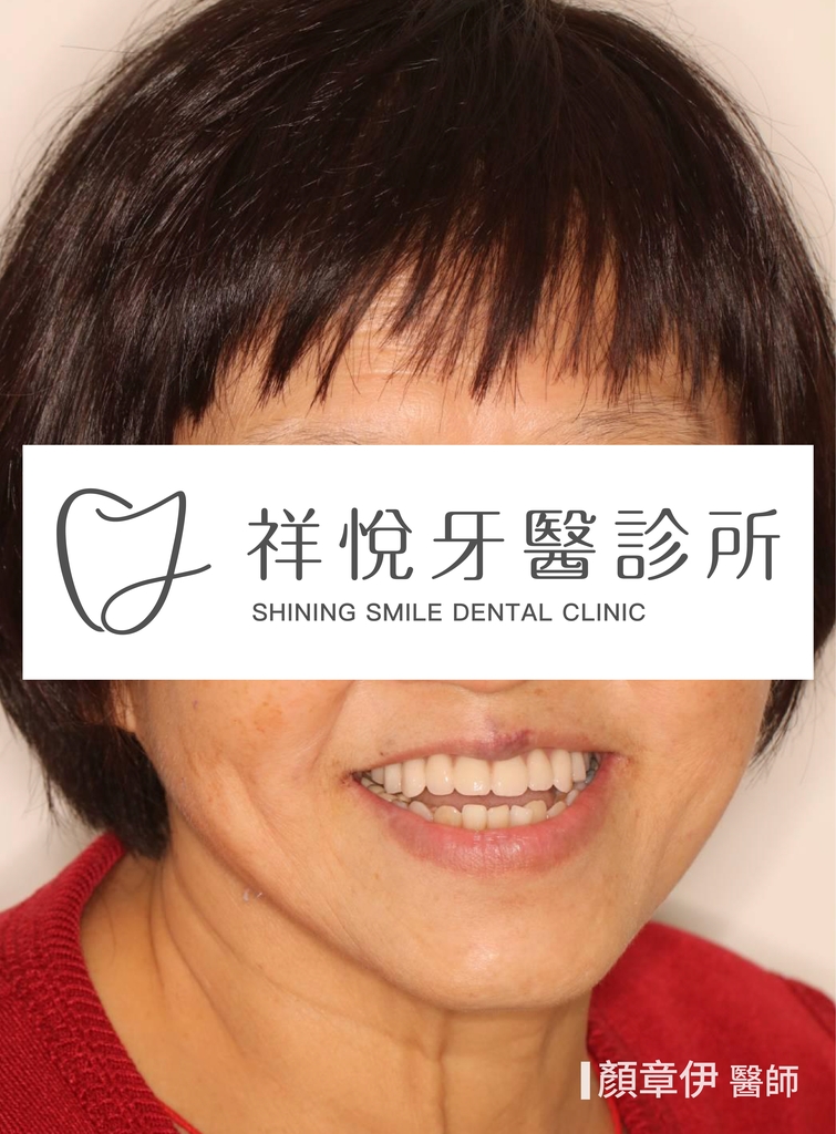 一日長城治療後