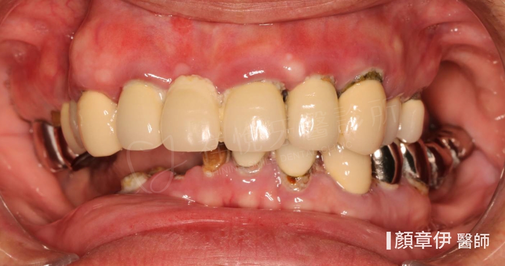 一日長城治療前