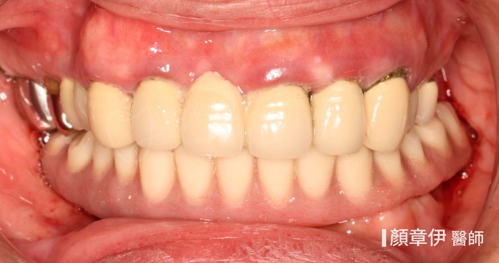 一日長城治療後