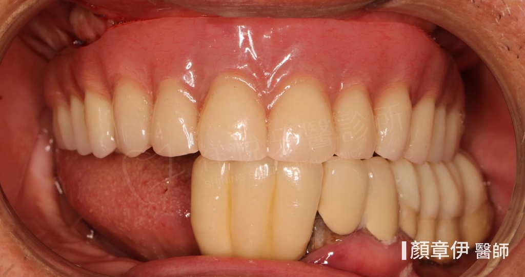 一日長城治療前