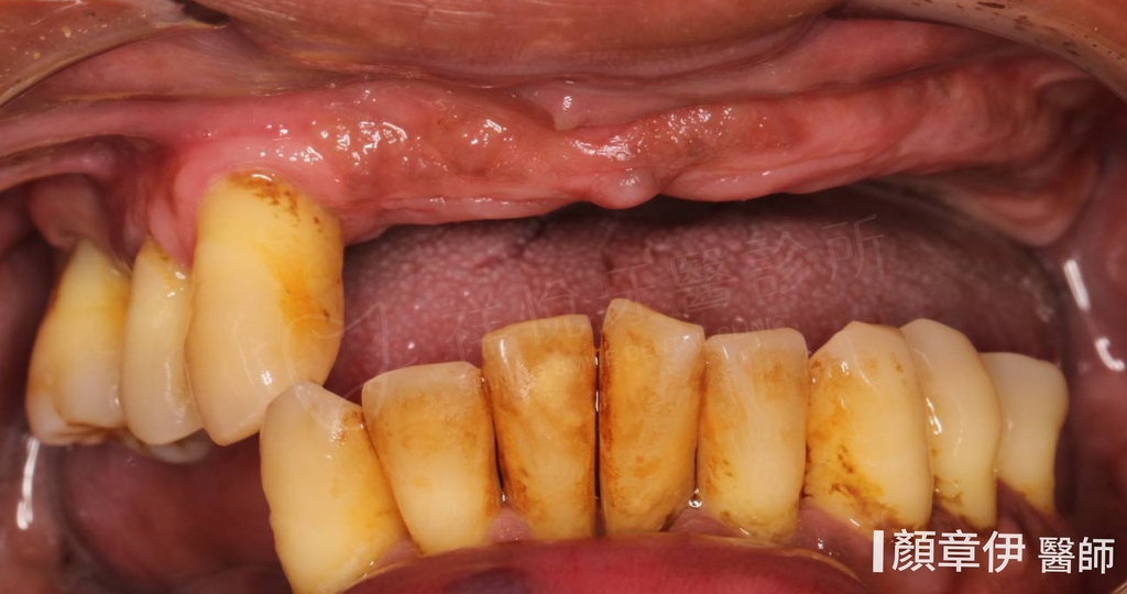 一日長城治療前