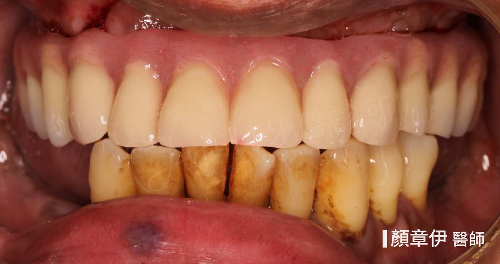 一日長城治療後