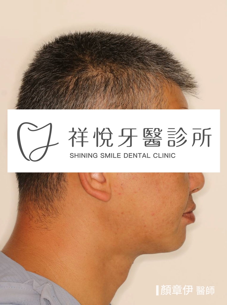 一日長城治療前