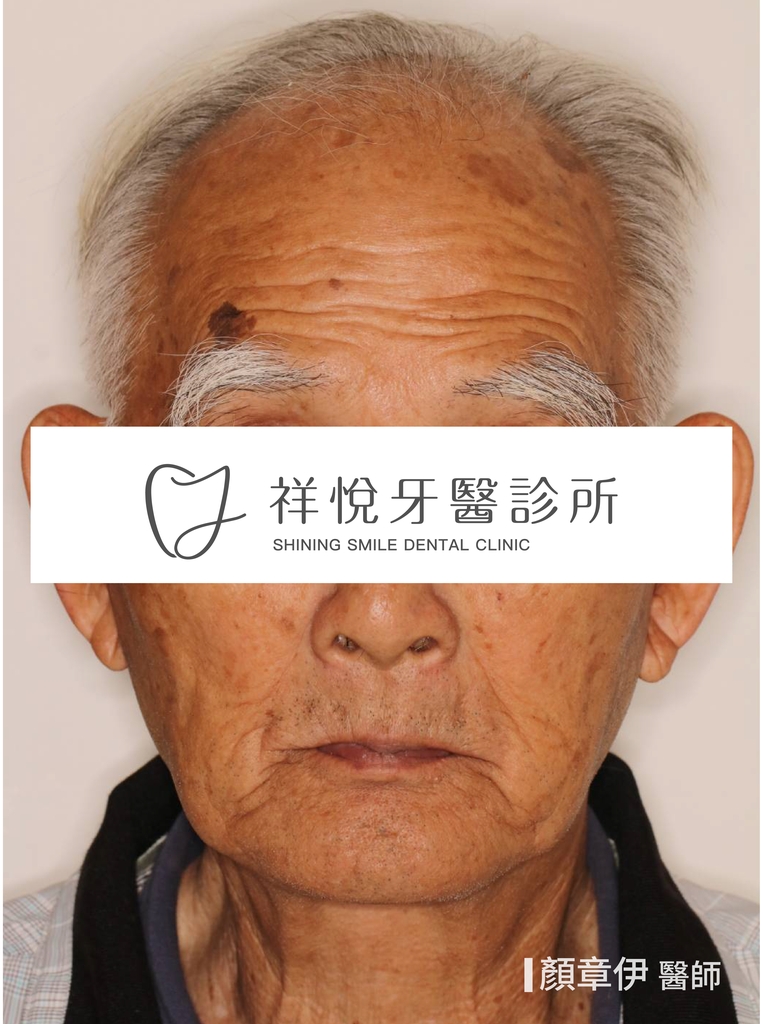 一日長城治療前