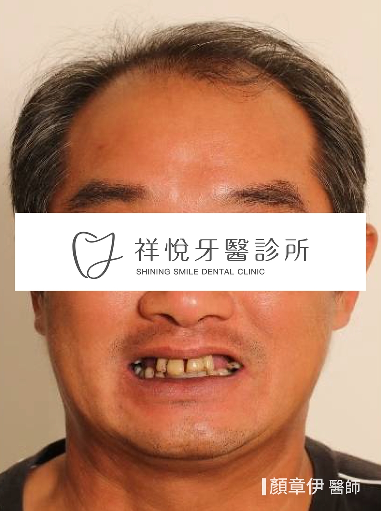 一日長城治療前