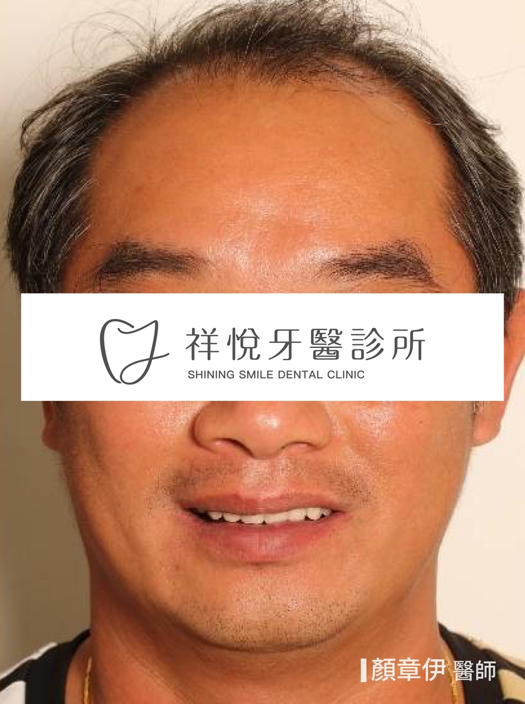 一日長城治療後