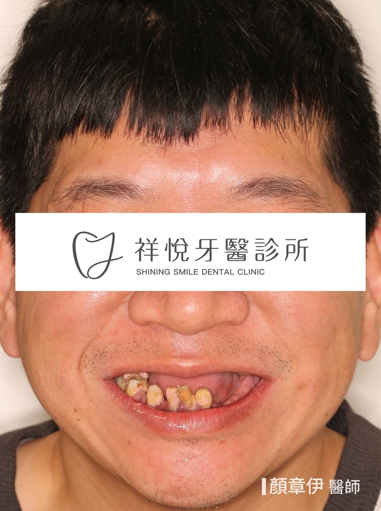 一日長城治療前