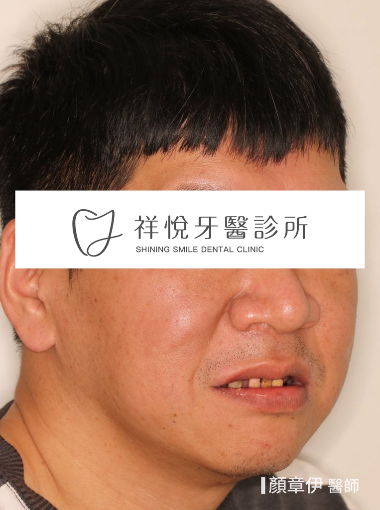 一日長城治療後