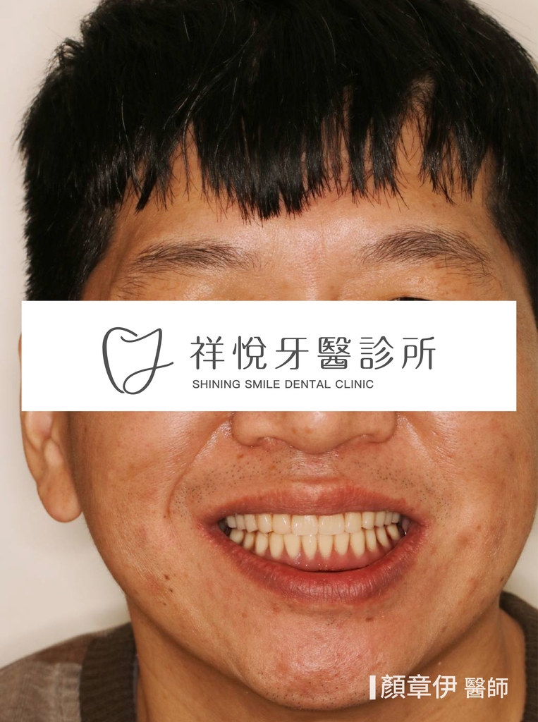 一日長城治療前