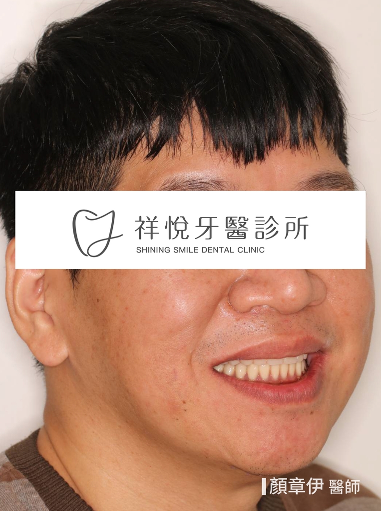 一日長城治療後