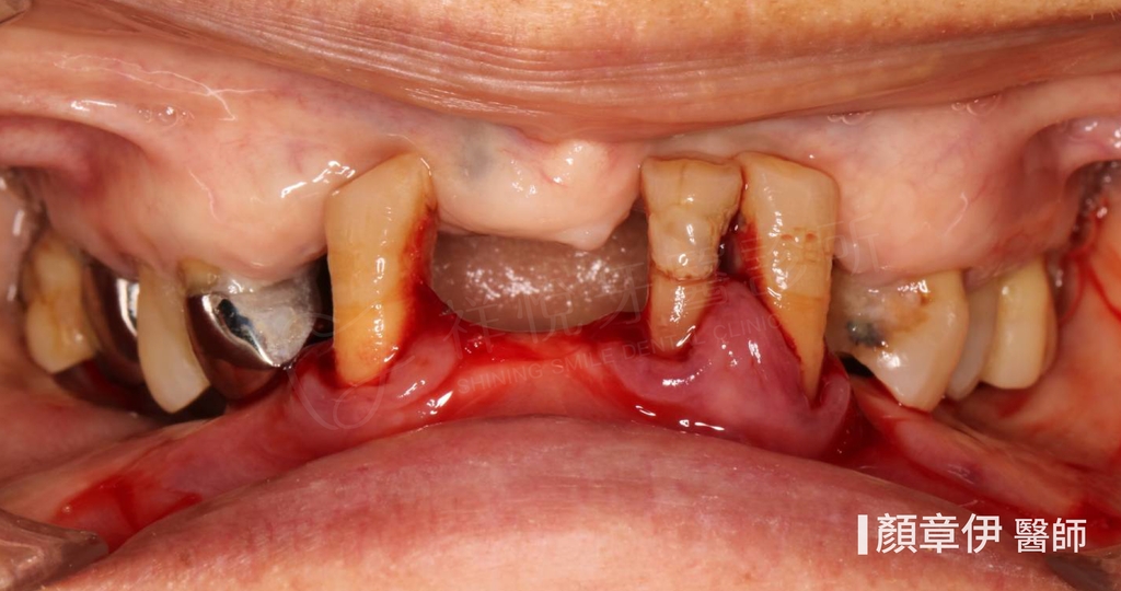 一日長城治療前