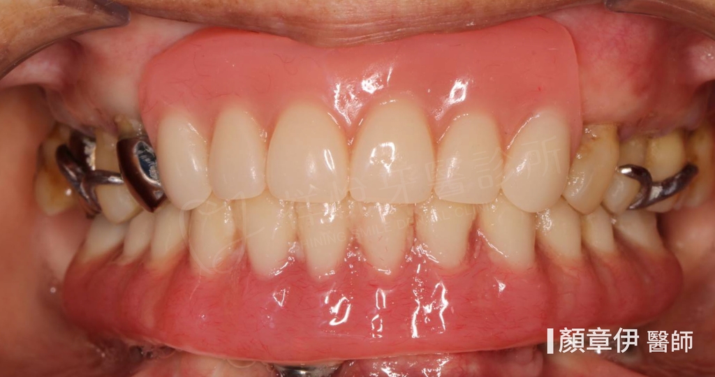 一日長城治療後