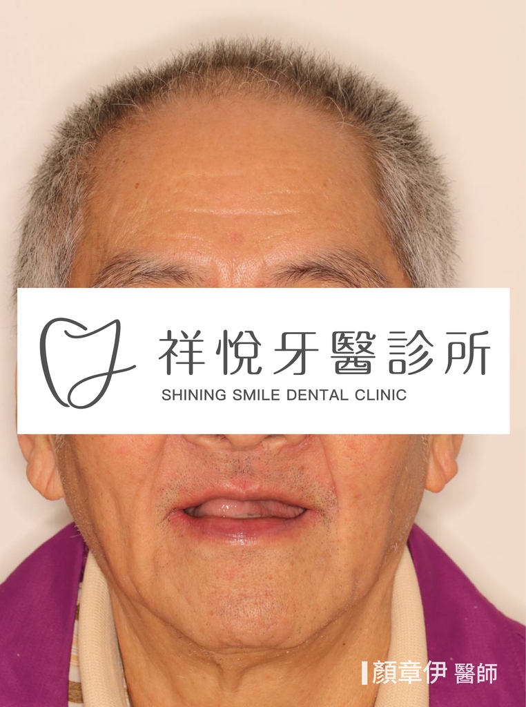 一日長城治療前