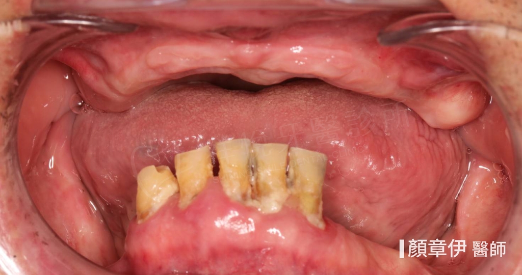 一日長城治療前