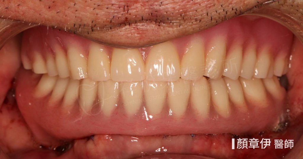 一日長城治療後