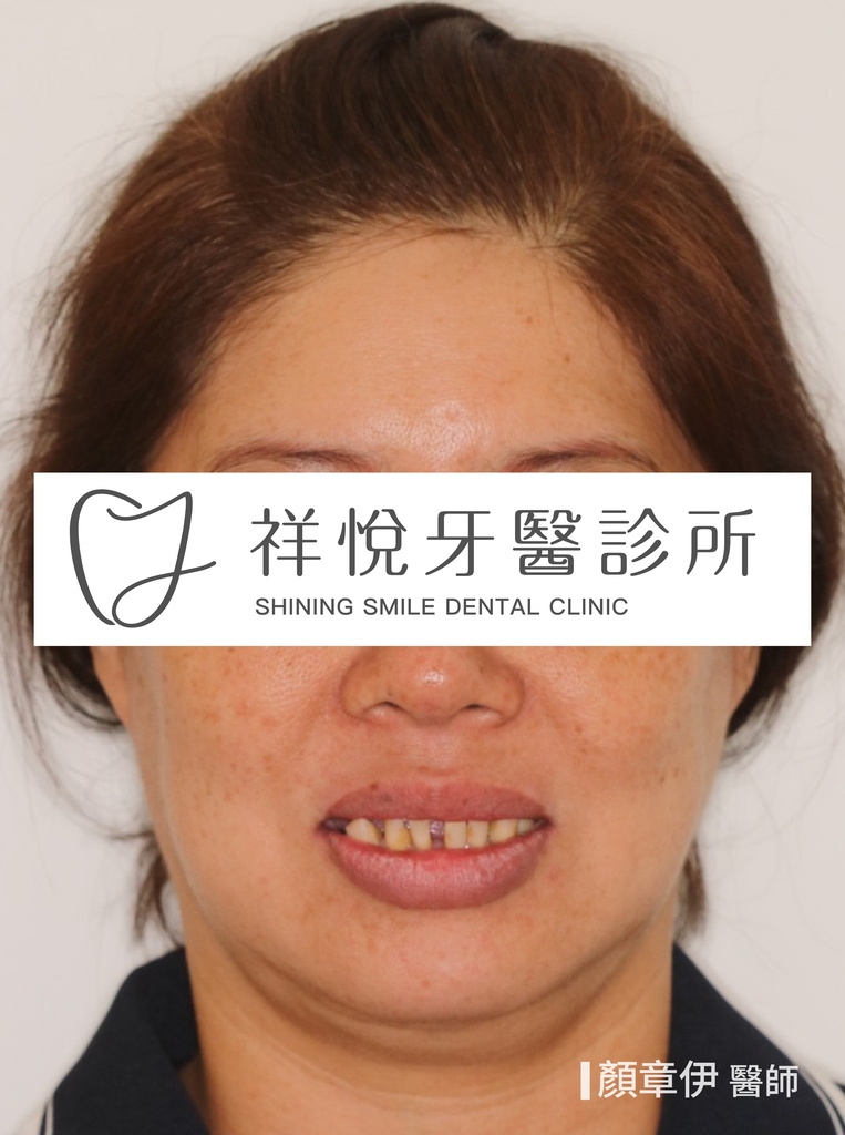 全口重建治療前