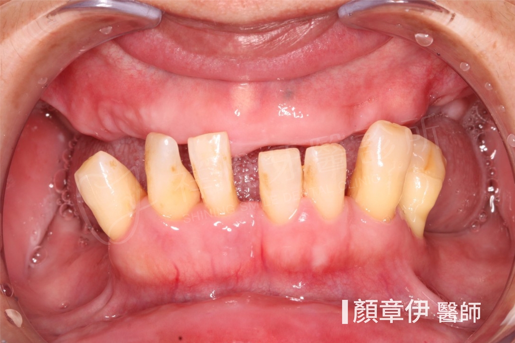 全口重建治療前