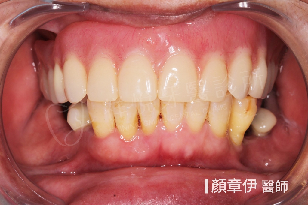 全口重建治療後