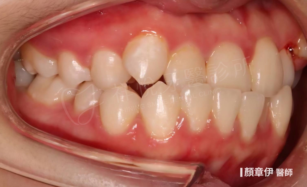 隱適美矯正治療前