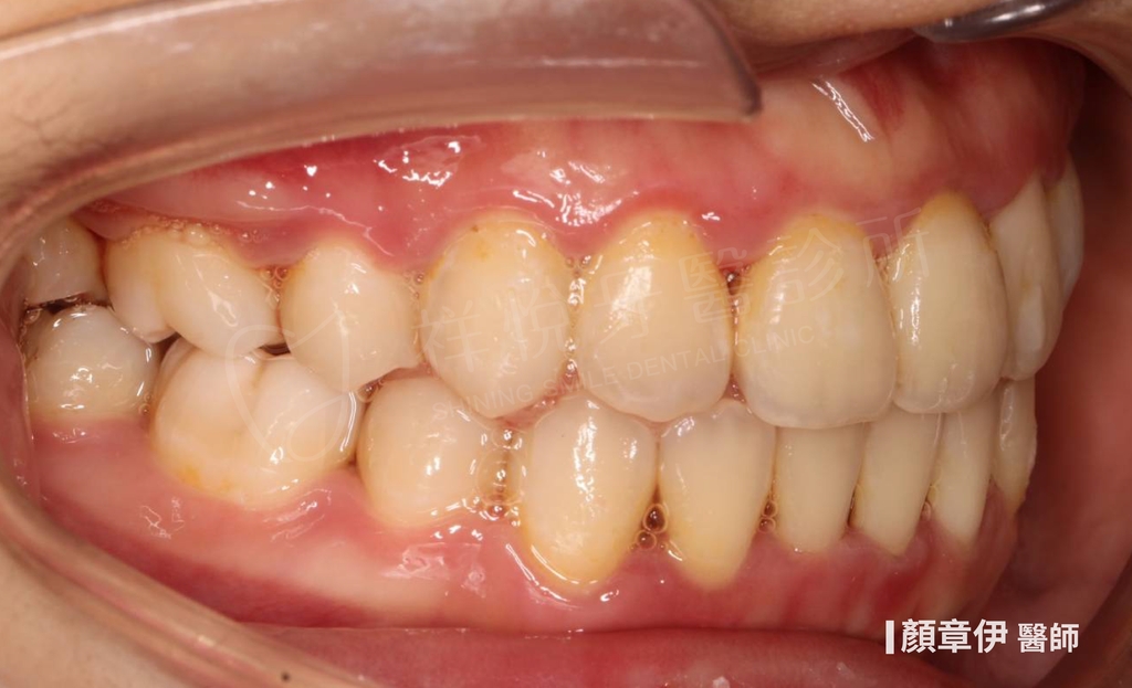 隱適美矯正治療後