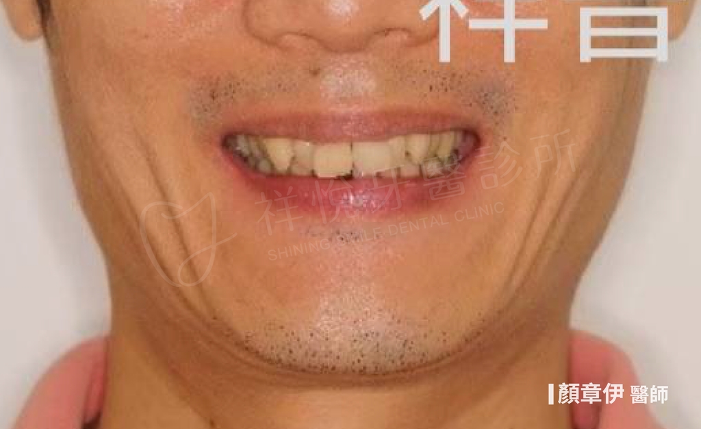 隱適美矯正治療後