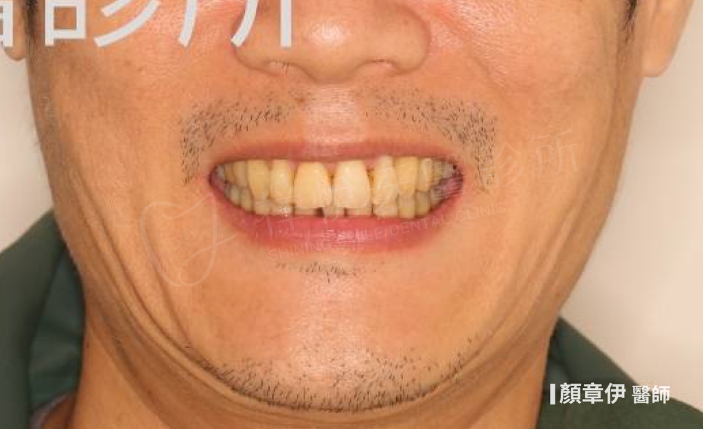 隱適美矯正治療後