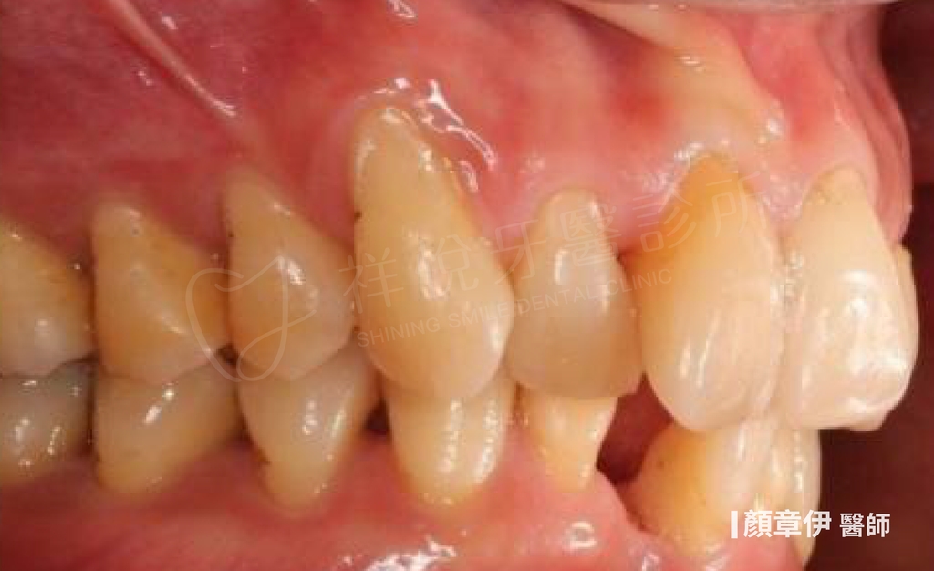 隱適美矯正治療前