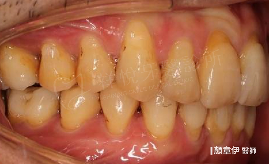 隱適美矯正治療後