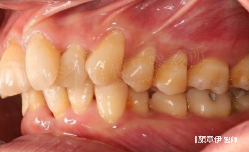 隱適美矯正治療前