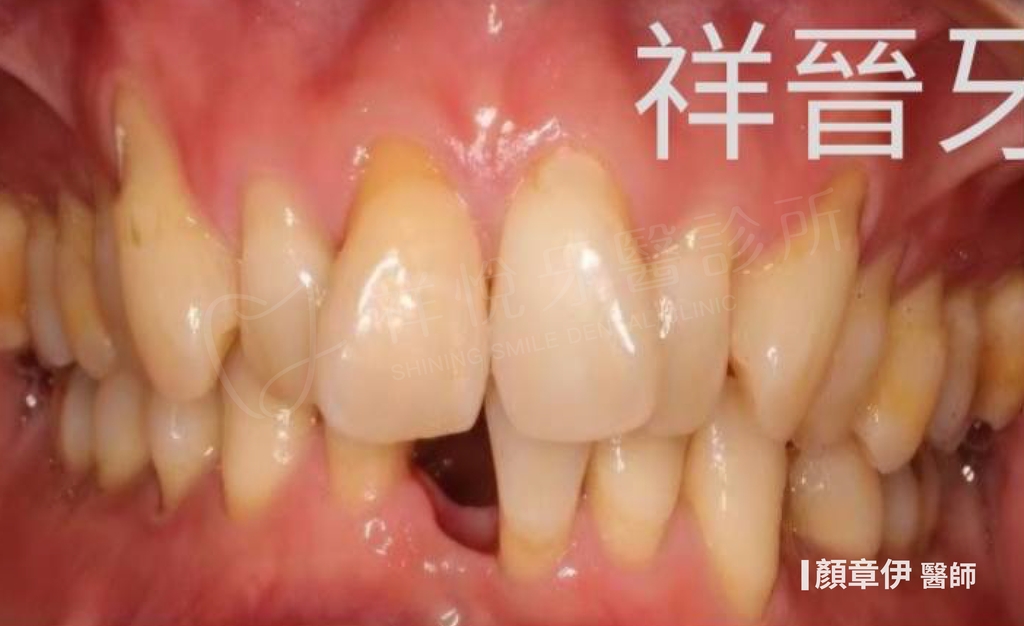 隱適美矯正治療前