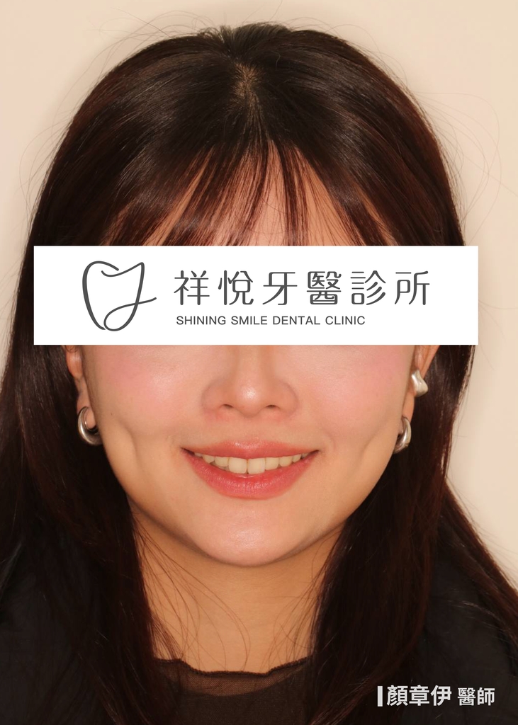 隱適美矯正治療後