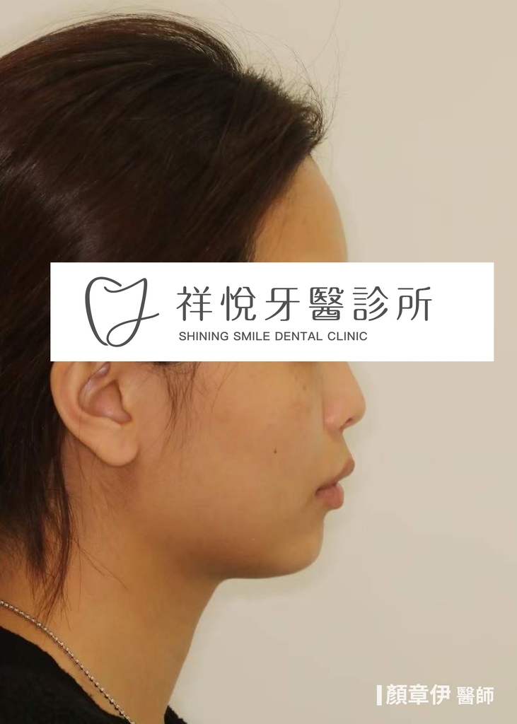 隱適美矯正治療前