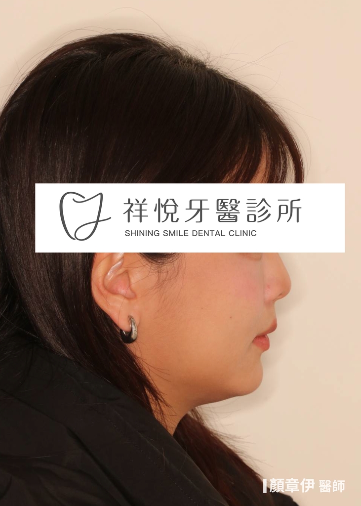 隱適美矯正治療後