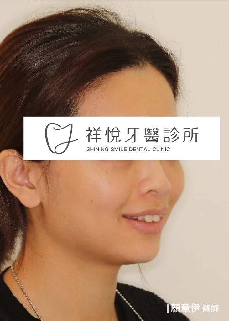 隱適美矯正治療前