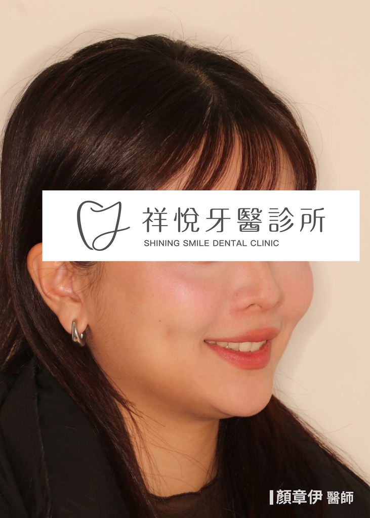 隱適美矯正治療後