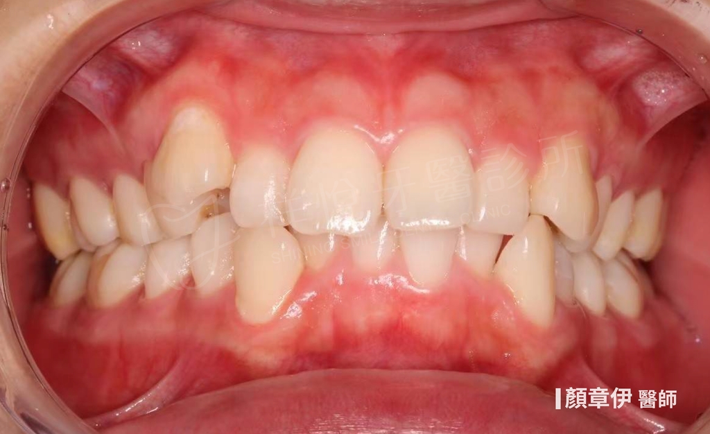 隱適美矯正治療前