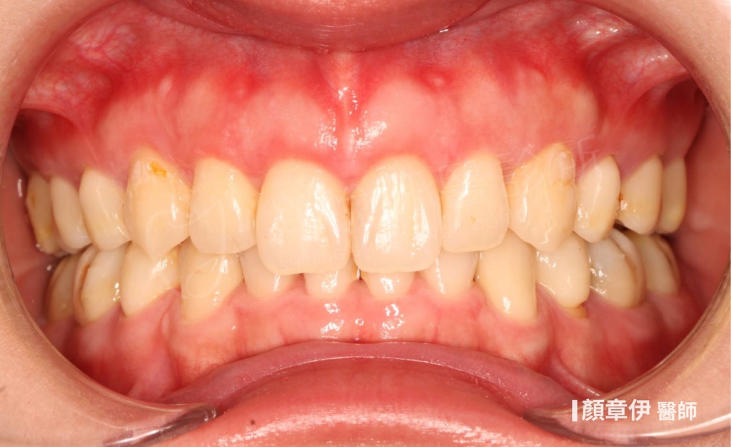 隱適美矯正治療後