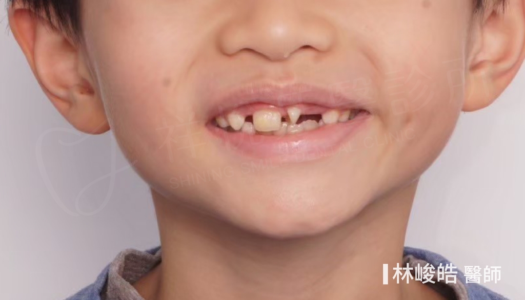 隱適美矯正治療前