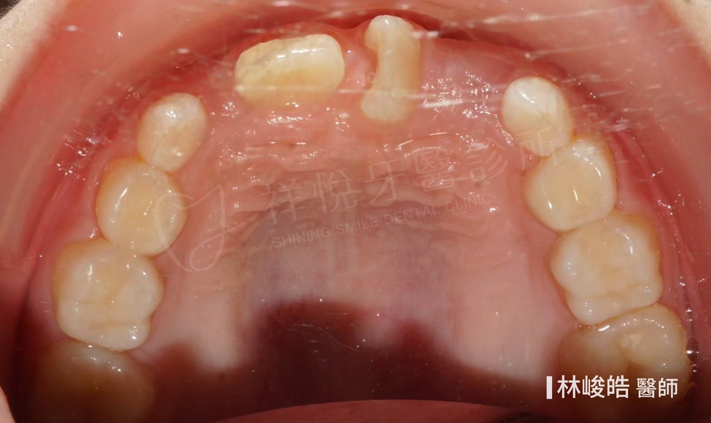 隱適美矯正治療前