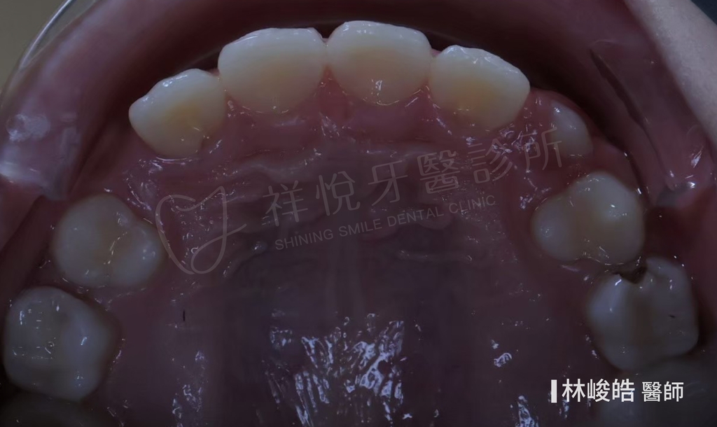 隱適美矯正治療後