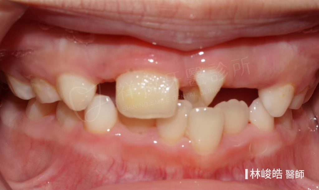 隱適美矯正治療前