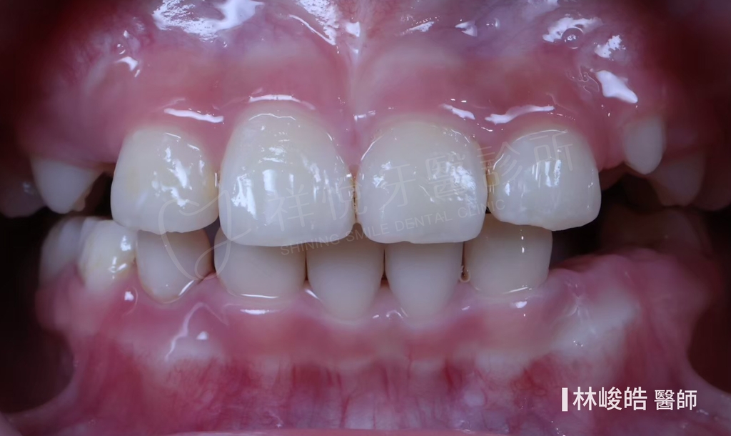 隱適美矯正治療後