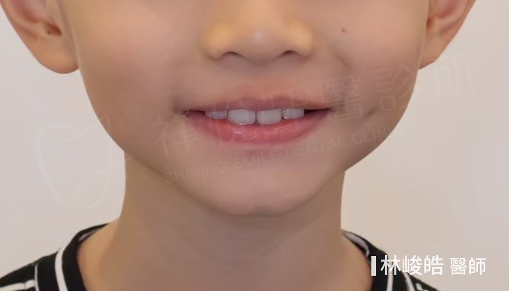 隱適美矯正治療後