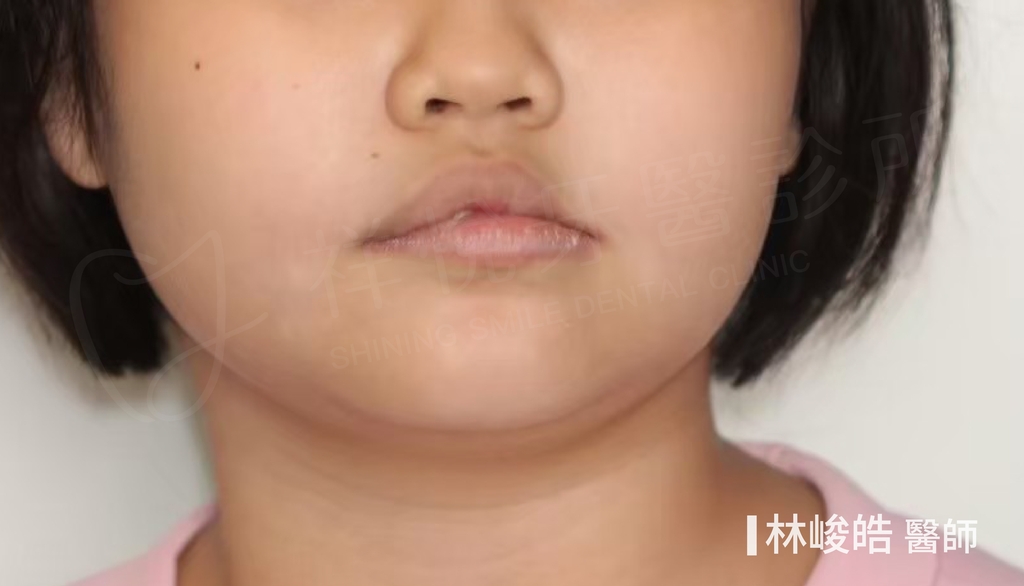 隱適美矯正治療前