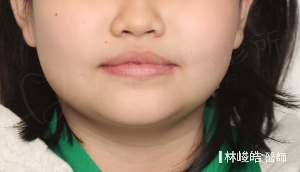 隱適美矯正治療後