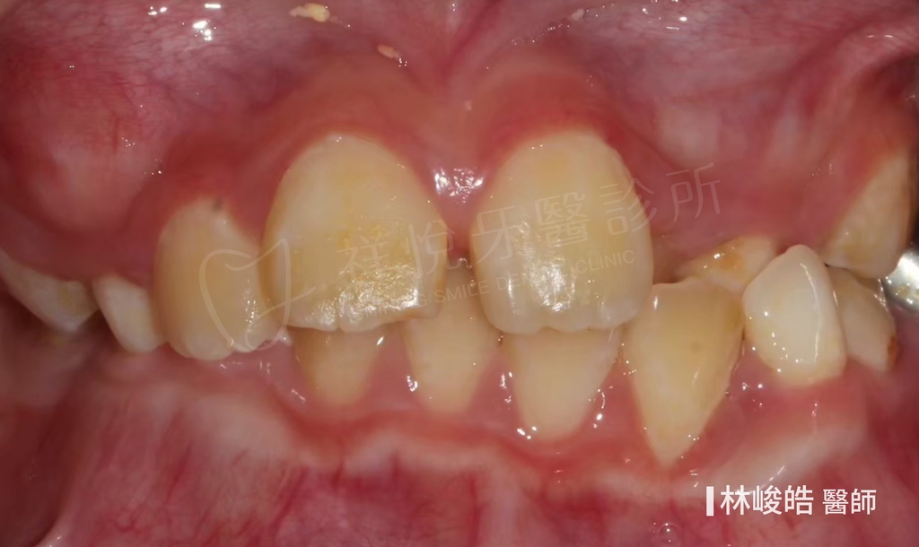 隱適美矯正治療前