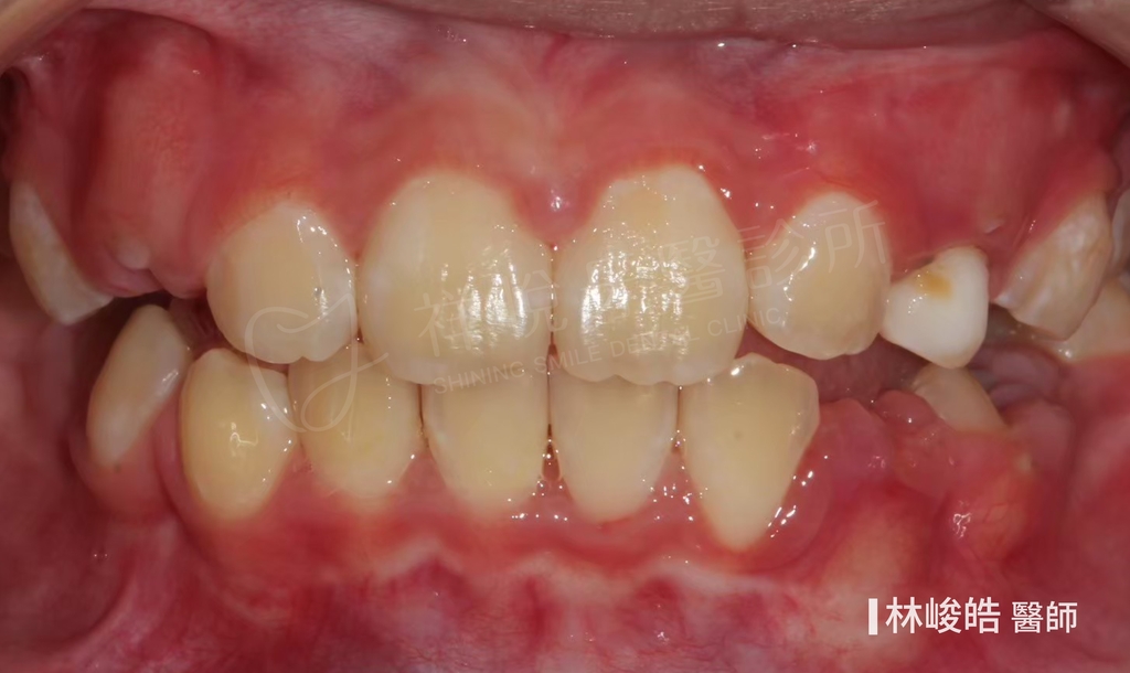 隱適美矯正治療後